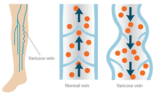 Radiofrequency Ablation for Varicose Veins